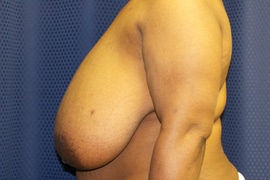 Breast Reduction 03 Before 3