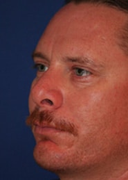 Chin Implants 01 After 3