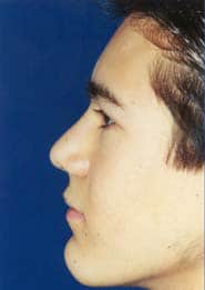 Rhinoplasty 01 Before 3
