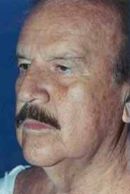 Neck Lift 03 Before 2