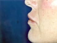 Lip Lift / Augmentation 03 After 2