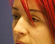 Rhinoplasty 05 Before