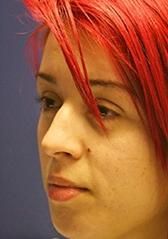 Rhinoplasty 05 Before 1