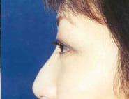 Eyelid Surgery 12 After 2