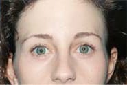 Brow Lift 02 After 1