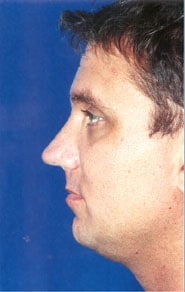 Buccal Fat Removal 02 Before 2