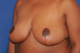 Breast Reduction 03 After 2