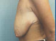 Breast Lift 05 Before 2