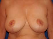 Breast Lift 03 After 1