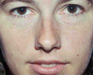 Rhinoplasty 08 Before