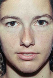 Rhinoplasty 08 Before 1