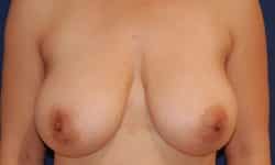 Breast Augmentation 10 After