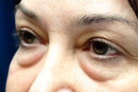 Eyelid Surgery 02 Before 2