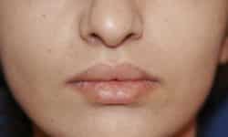 Lip Lift / Augmentation 01 After