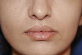 Lip Lift / Augmentation 01 After 1