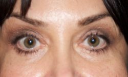 Eyelid Surgery 02 After