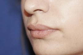 Lip Lift / Augmentation 01 Before 2