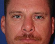 Chin Implants 01 After