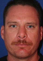 Chin Implants 01 After 1