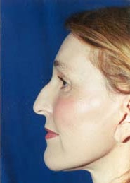 Brow Lift 01 After 3