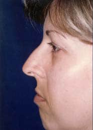 Rhinoplasty 10 Before 2