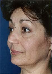 Facelift 05 Before 2