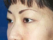 Eyelid Surgery 12 Before 1