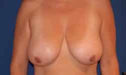 Breast Lift 01 Before