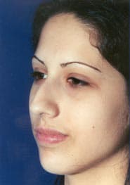 Rhinoplasty 07 Before 2