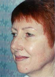 Facelift 07 Before 2