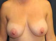 Breast Lift 04 Before 1