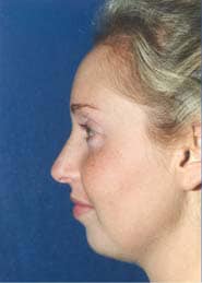 Chin Implants 02 Before 2