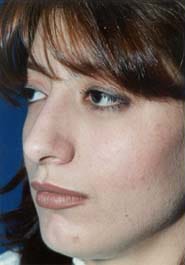 Rhinoplasty 03 Before 2