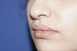 Lip Lift / Augmentation 01 After 2