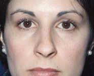 Rhinoplasty 04 Before