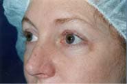 Eyelid Surgery 08 Before 2