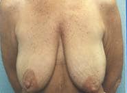 Breast Lift 05 Before 1