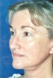 Neck Lift 04 After 2