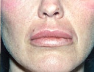 Lip Lift / Augmentation 03 After 1