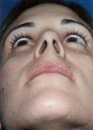 Rhinoplasty 04 After 3