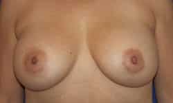 Breast Implant Exchange 01 After