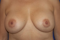 Breast Implant Exchange 01 After 1