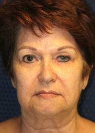 Facelift 04 Before 1