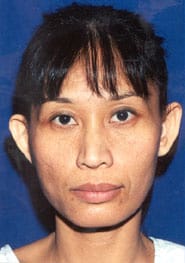 Otoplasty 01 Before 1