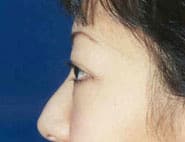 Eyelid Surgery 12 Before 2