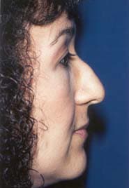 Rhinoplasty 02 Before 3