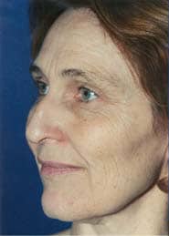 Brow Lift 01 Before 2