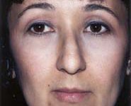 Rhinoplasty 02 Before