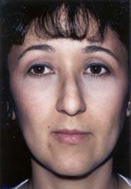 Rhinoplasty 02 Before 1