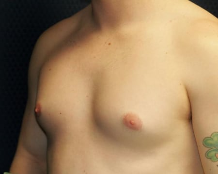 Gynecomastia 01 Before 2